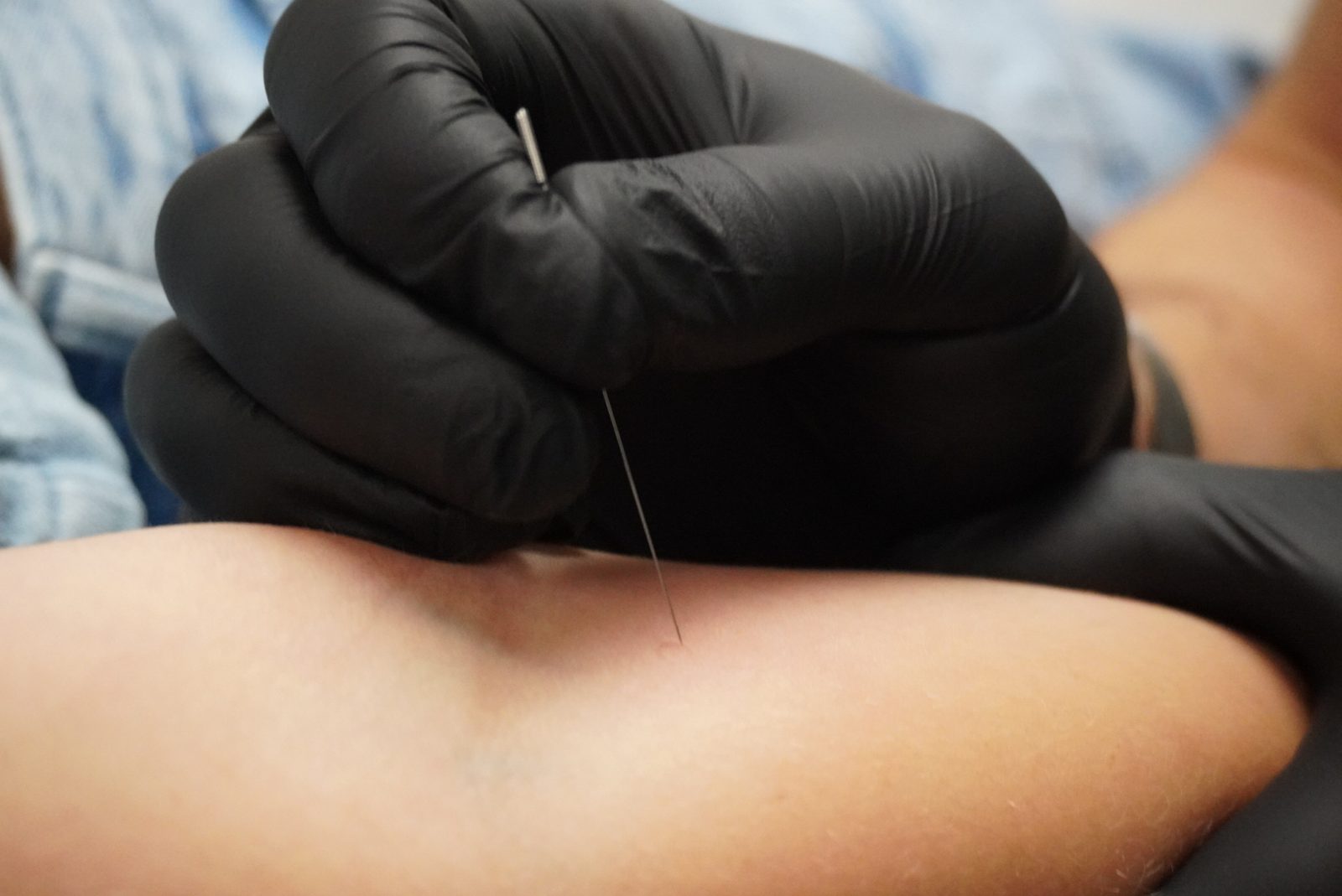 Dry needling treatment being performed on a patient's thigh at Valley PT